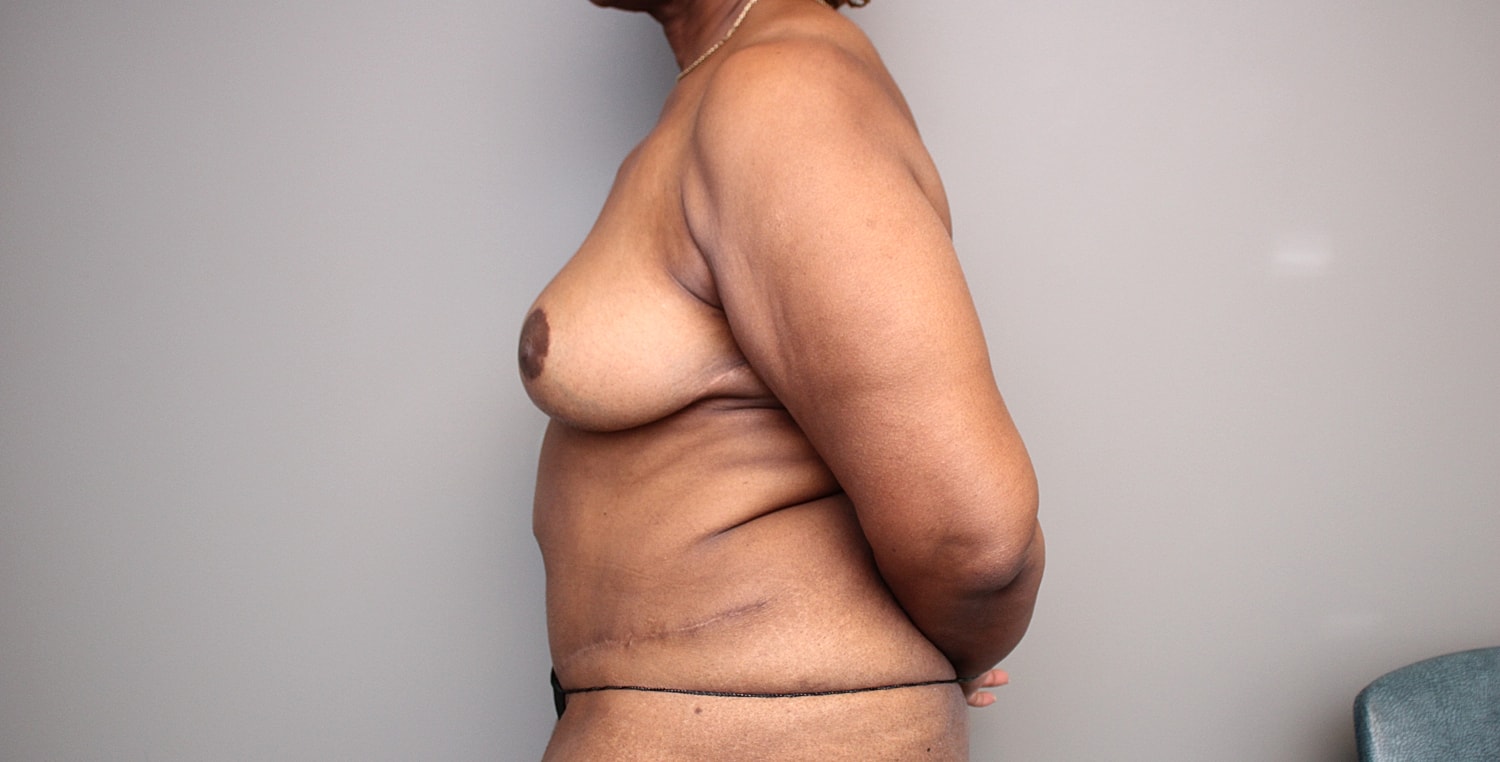 Breast Reduction Before & After