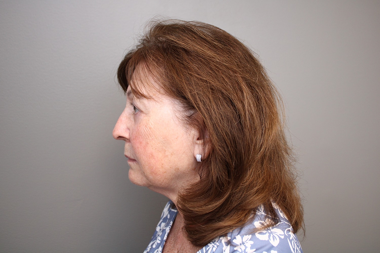 Blepharoplasty Before & After