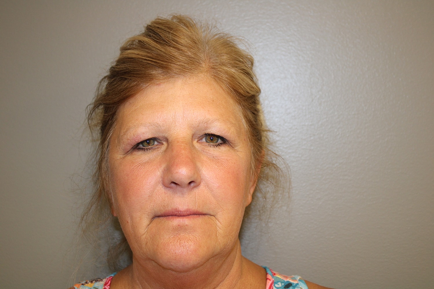 Blepharoplasty Before & After