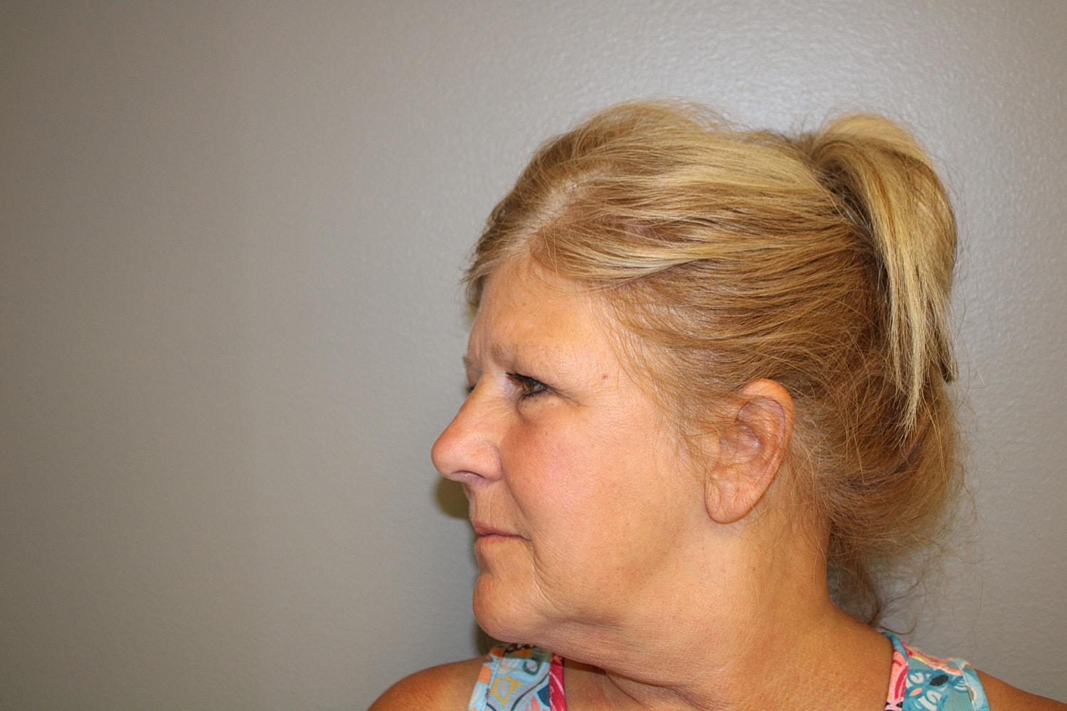 Blepharoplasty Before & After