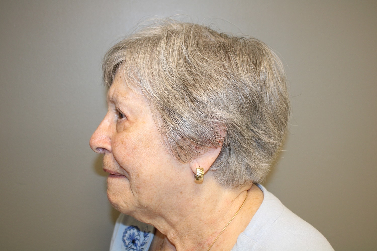 Blepharoplasty Before & After